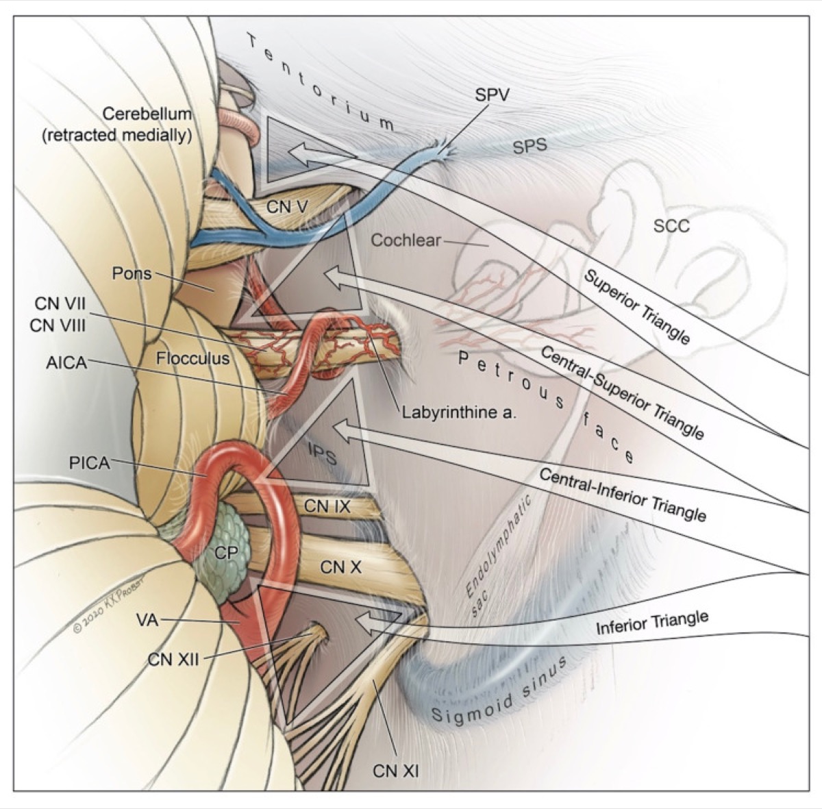 Step-by-step retrosigmoid dissection: inverted-U incision → myocutaneous flap → craniotomy exposing sigmoid/transverse edges → Y-shaped dural opening over the cerebellum
