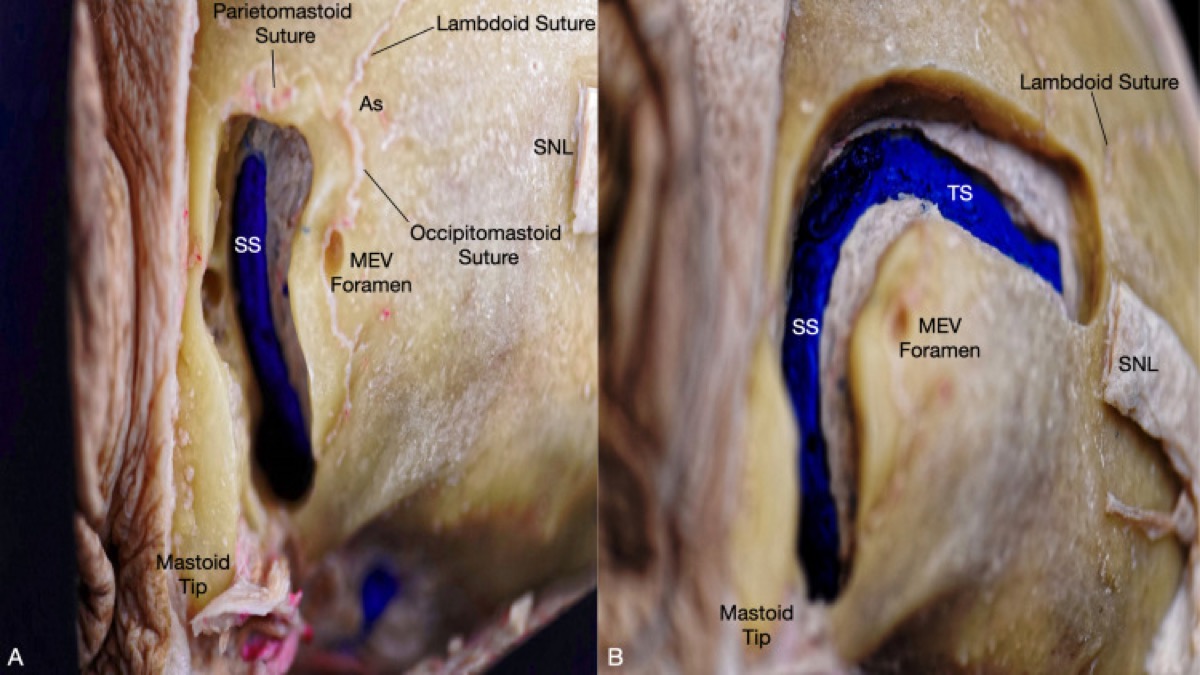 Sigmoid/transverse sinuses and their relation to the asterion and superior nuchal line
