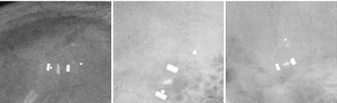 More radiograph examples of a Codman CERTAS Plus Programmable Valve