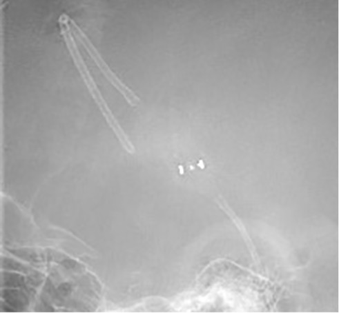 Radiograph of a Codman CERTAS Plus Programmable Valve