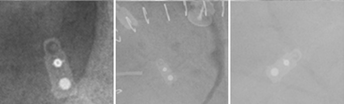Radiograph of a Codman HAKIM Precision Fixed Pressure Valve