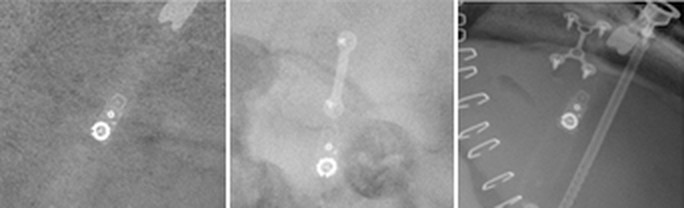 More radiograph examples of a Codman HAKIM Programmable Valve