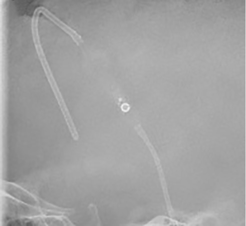 Radiograph of a Codman HAKIM Programmable Valve