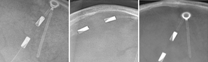 Radiograph of a Integra DP Valve System