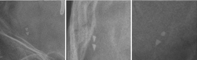 Radiograph of a Medtronic PS Medical Delta Valve