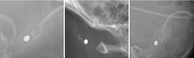 Radiograph of a Medtronic PS Medical Strata / Strata II Adjustable Pressure Valve