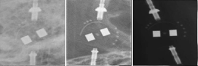 Radiograph of a Sophysa Polaris Adjustable Pressure Valve
