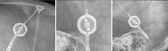 Radiograph of a Miethke proGAV