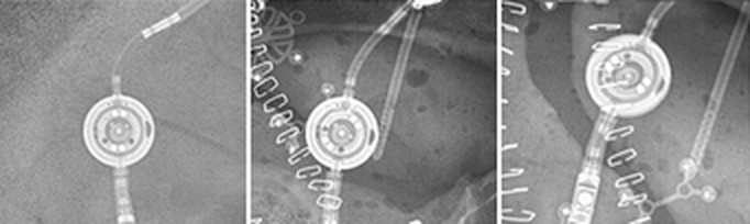 More radiograph examples of a Miethke proGAV 2.0 (B. Braun / Aesculap)
