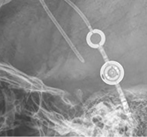 Radiograph of a Miethke proGAV 2.0 (B. Braun / Aesculap)