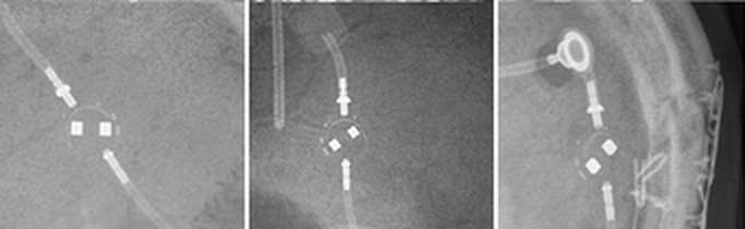 More radiograph examples of a Sophysa Sophy Mini SM8 Adjustable Pressure Valve