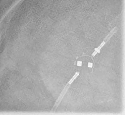 Radiograph of a Sophysa Sophy Mini SM8 Adjustable Pressure Valve