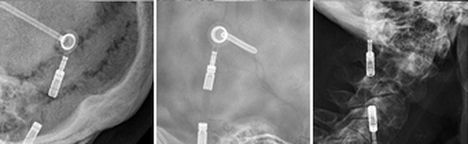 Radiograph of a Spitz-Holter valve (historic, 1956)