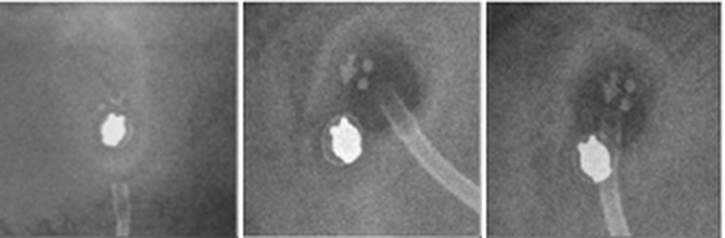 Radiograph of a Medtronic PS Medical Strata NSC Adjustable Pressure Valve (incl. NSC LP)