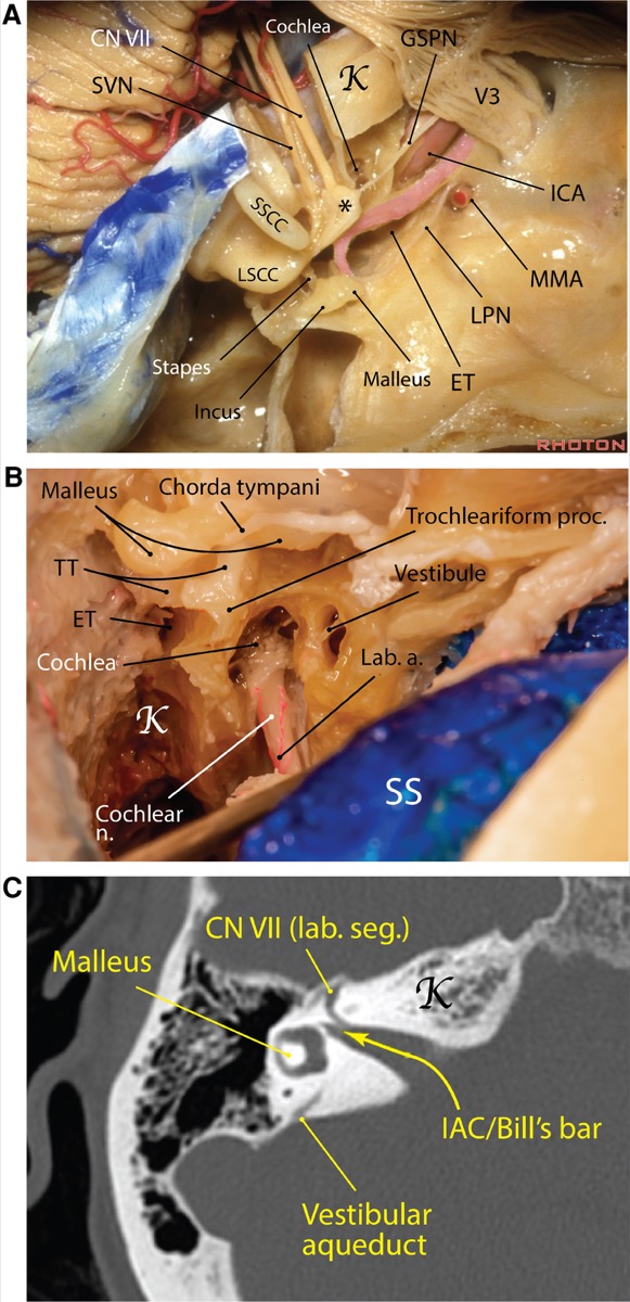 Petrous carotid canal, GSPN, and the IAC within the middle-fossa floor
