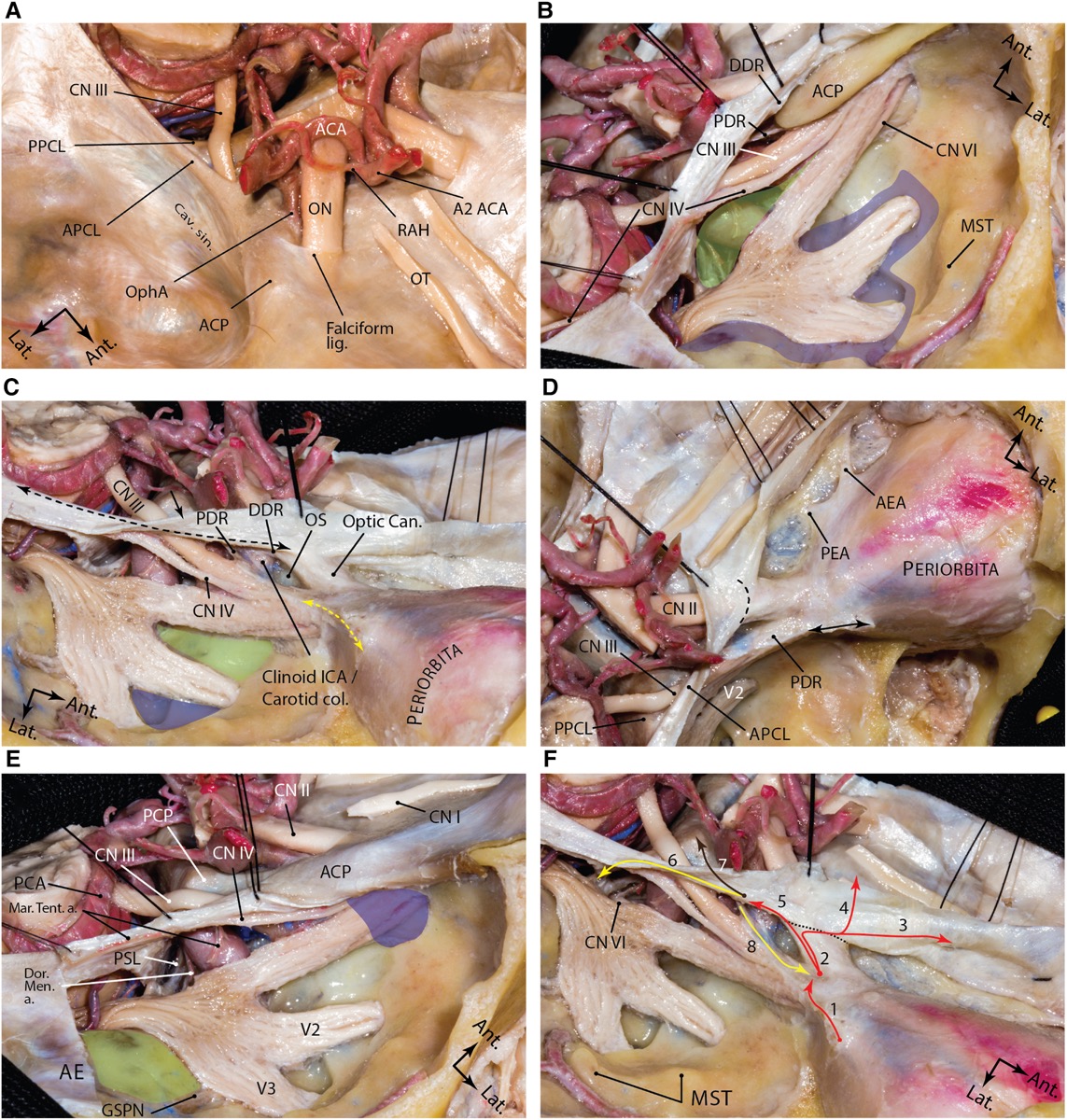 Middle-fossa dural anatomy — Meckel's cave, cavernous sinus, and dural rings
