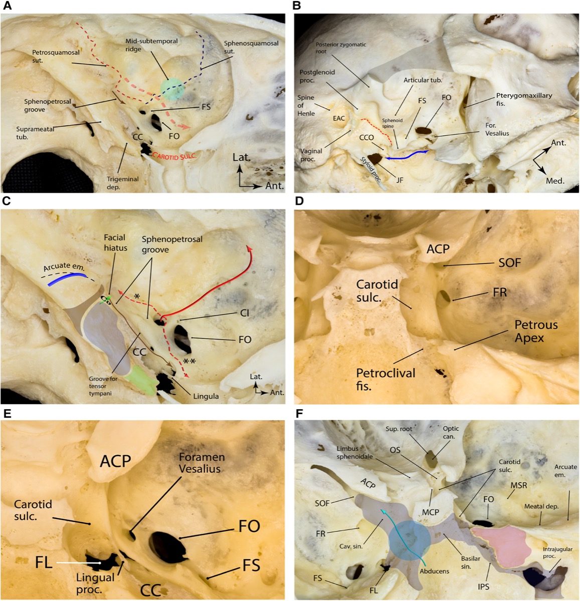 Bony landmarks of the middle fossa proper — foramina (spinosum, ovale, rotundum), arcuate eminence, petrous apex, and Kawase's rhomboid