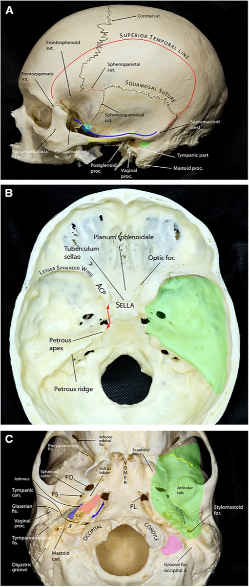 Bony anatomy of the middle cranial fossa (lateral skull, endocranial floor, exocranial base)