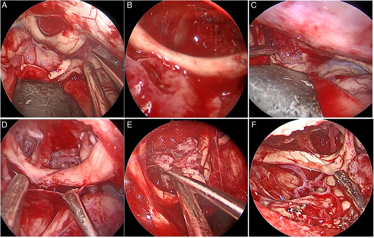 Endoscopic intradural view — tuberculum/suprasellar tumor displacing the optic nerve, and the field after resection