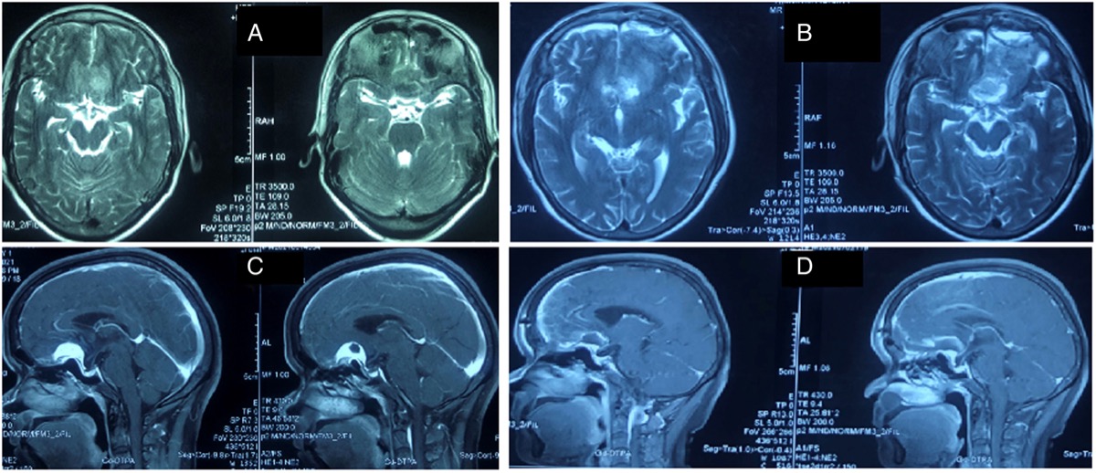 Preoperative and postoperative MRI — tuberculum sellae meningioma resected through the eyebrow keyhole
