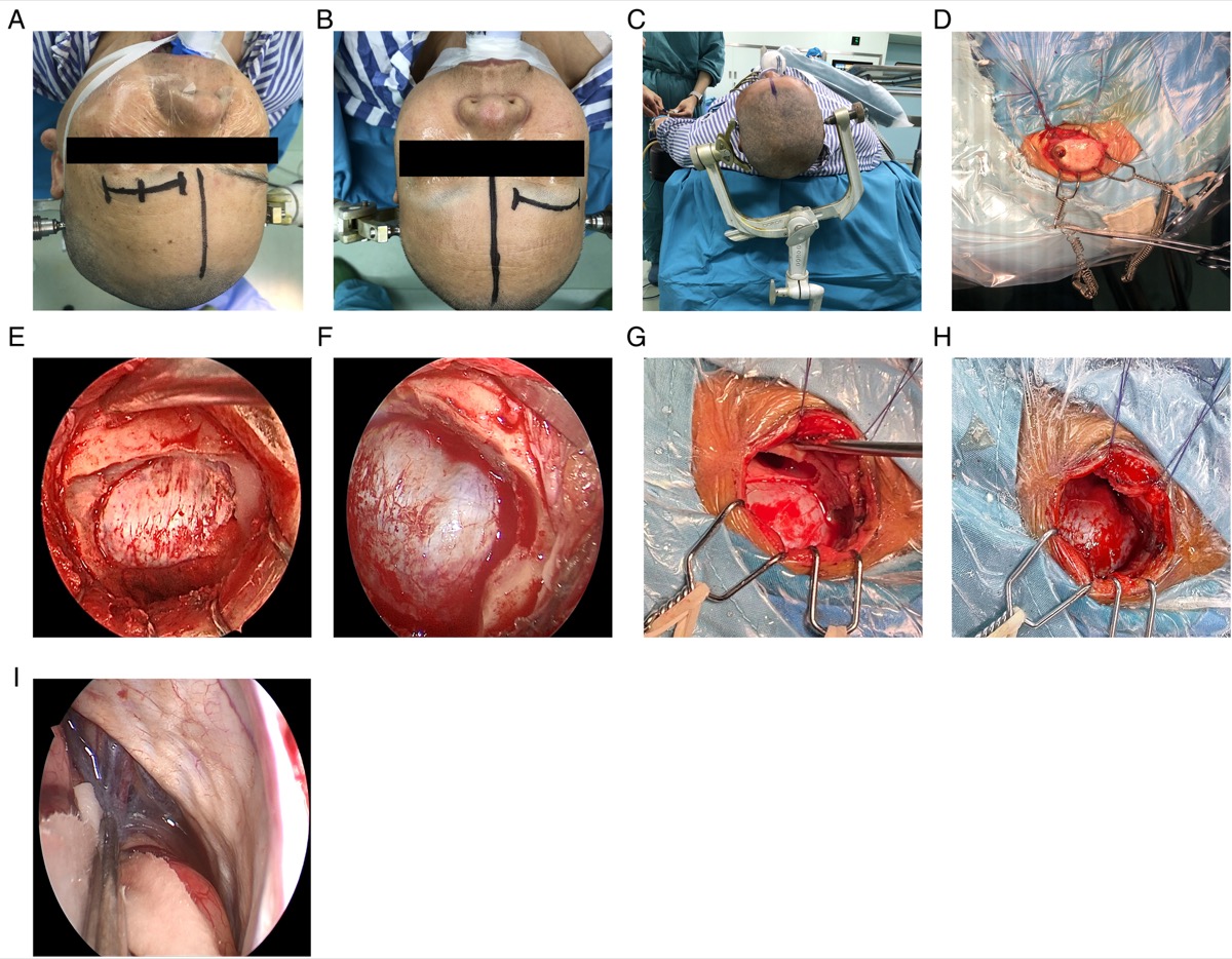 Operative steps — eyebrow incision location, head fixation, fishhook retraction, small free frontal bone flap, supraorbital nerve, and frontal-sinus management with CSF release