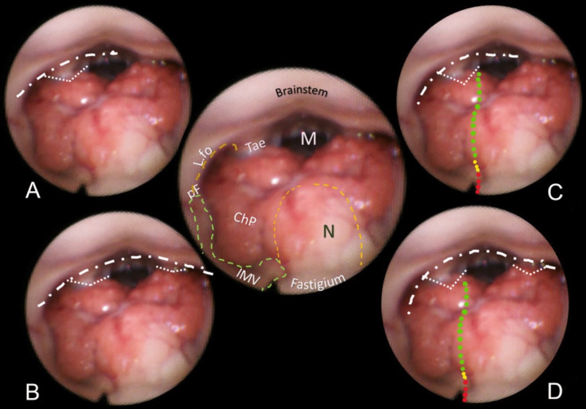Normal fourth ventricle — telovelar, lateral-recess, and extended approach variants