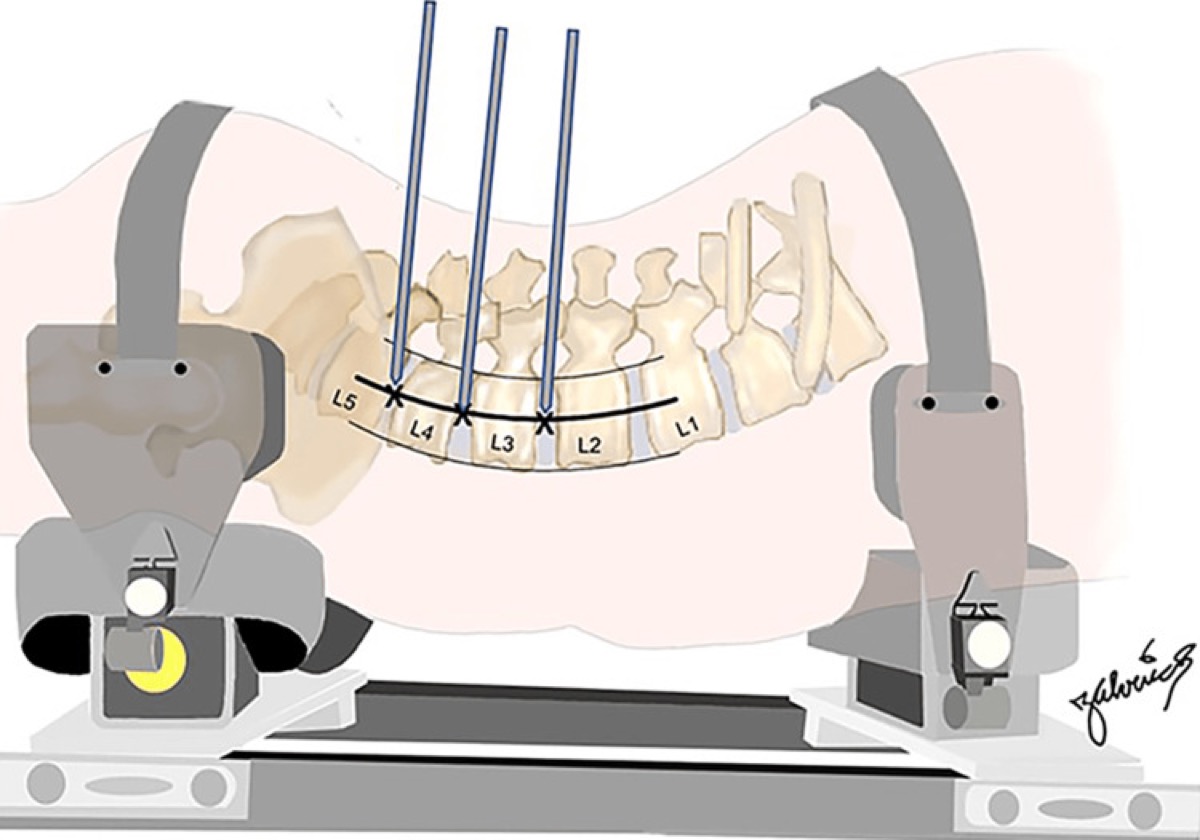 Lateral approach trajectory — pins targeting the L2-3/L3-4/L4-5 disc centers
