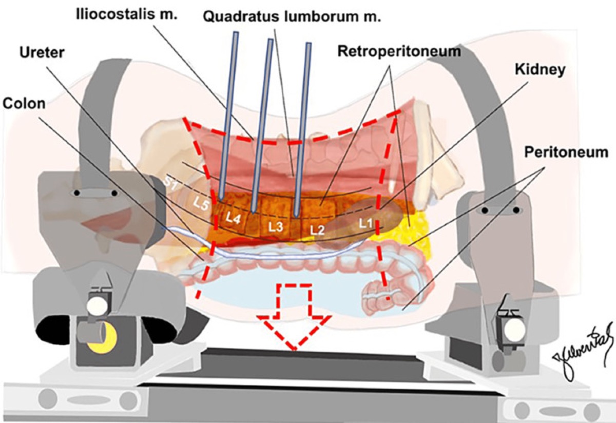 Retroperitoneal anatomy via the flap incision — quadratus lumborum, psoas & peritoneum