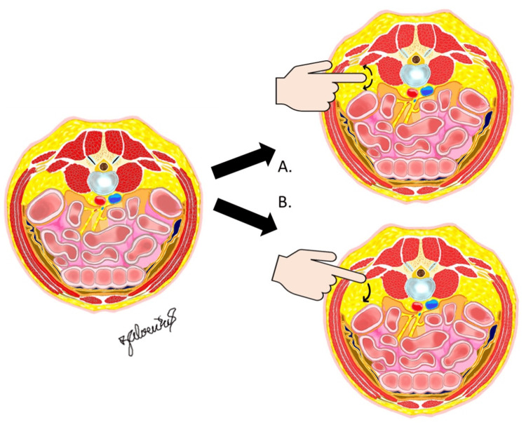 Developing the retroperitoneal space — direct-lateral vs posterolateral (QL landmark) finger sweep