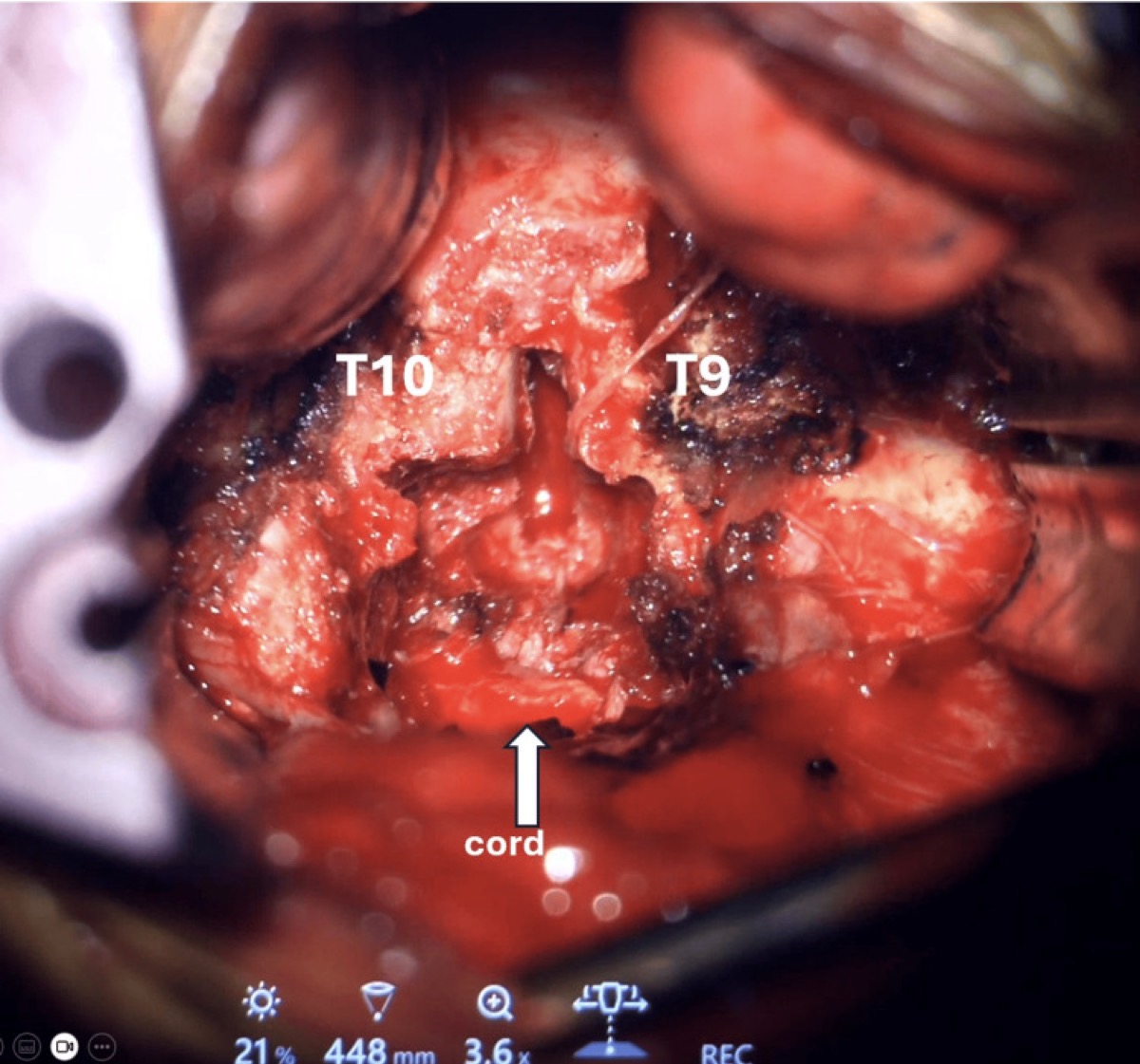 Box-shaped vertebral cavity created for ventral decompression
