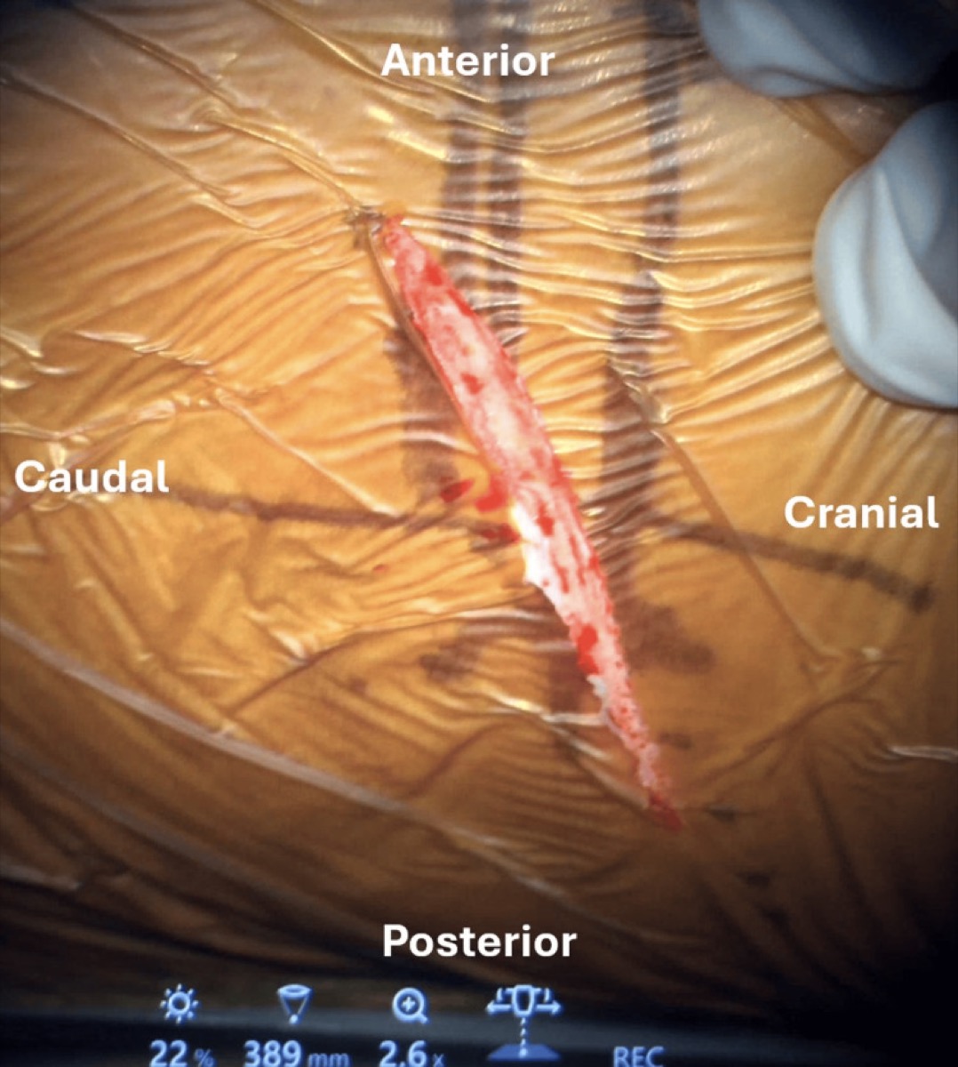 Mini-thoracotomy — skin incision parallel to the rib (lateral decubitus)