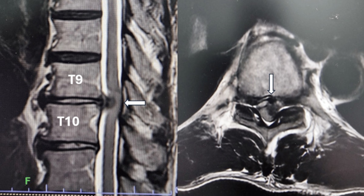 Preoperative MRI — paracentral T9/T10 disc compressing the cord (ventral target)